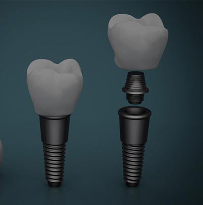 dental implants near me in la grange