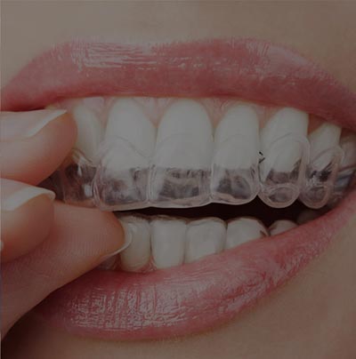 invisalign near me in LaGrange, IL, 60525