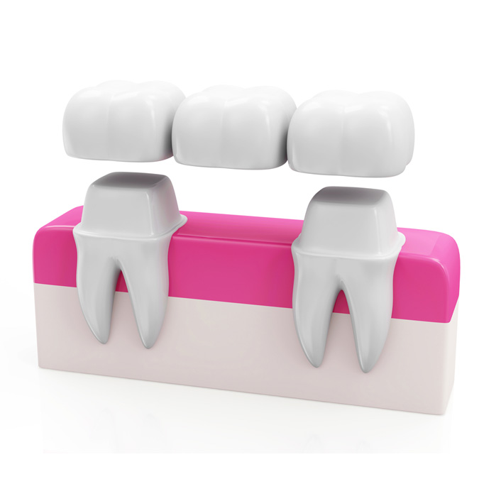 Dental Bridges near me - Dental Services