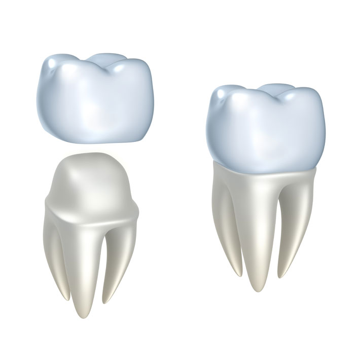 Crowns - Complete Dental Services in LaGrange, IL, 60525