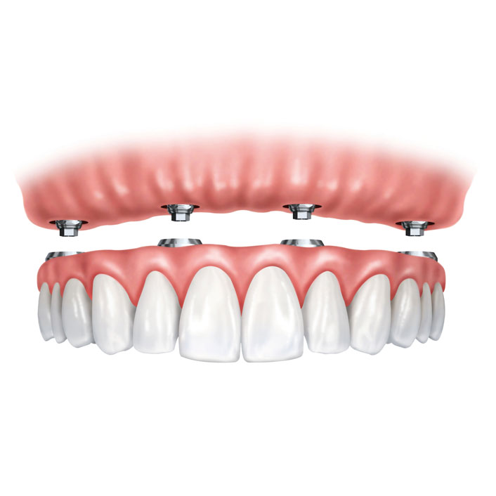 Implant-Supported Dentures - Dental Services