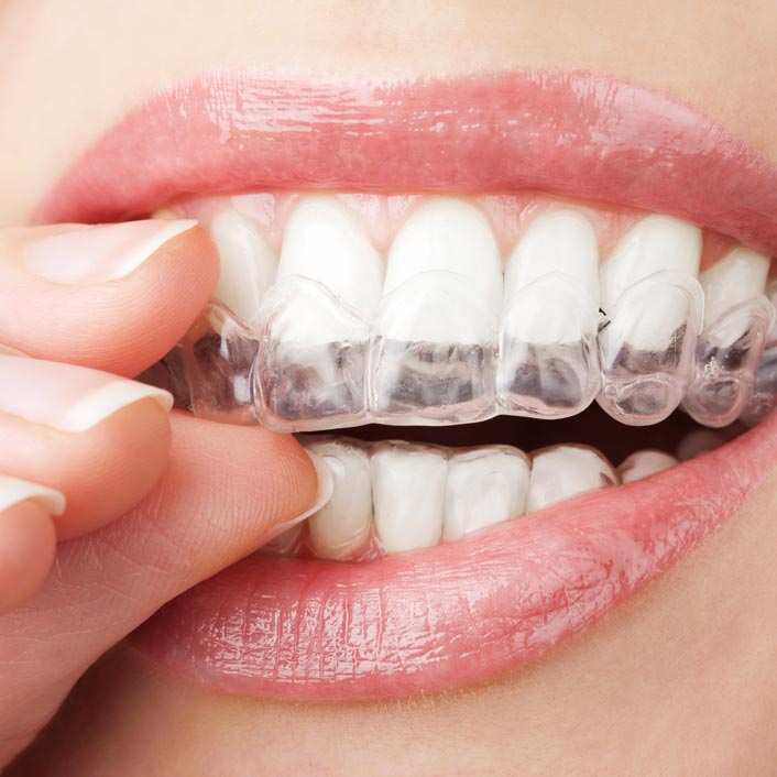 Invisalign<sup>®</sup> - Dental Services