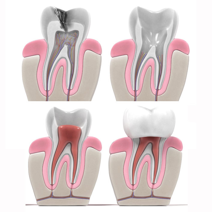 Root Canal - Dental Services
