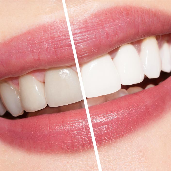 Teeth Whitening Neat me in LaGrange, IL, 60525